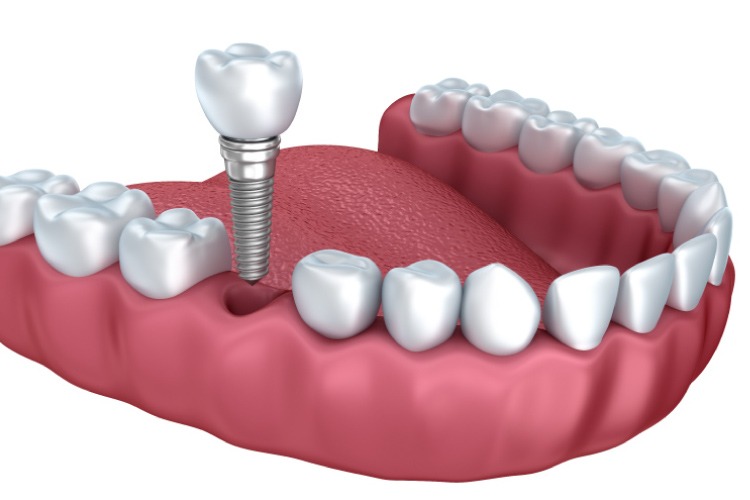 Model of the lower jaw showing a dental implant and crown