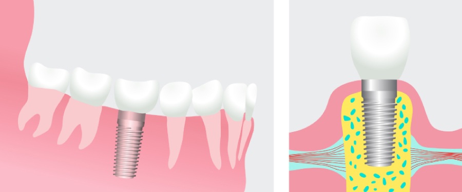 Graphic showing a dental implant in the jawbone.