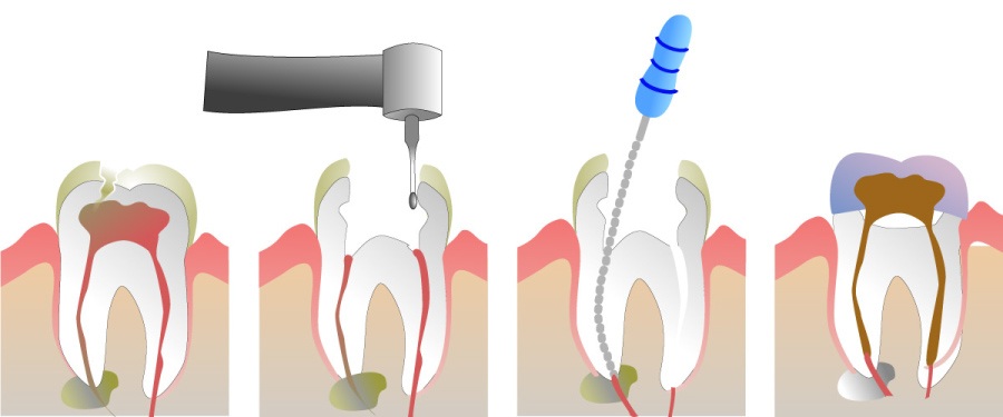 Graphic showing the stages of a root canal.