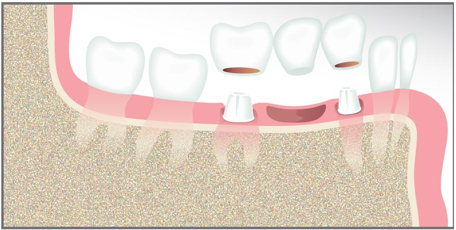 Illustration of a dental bridge.