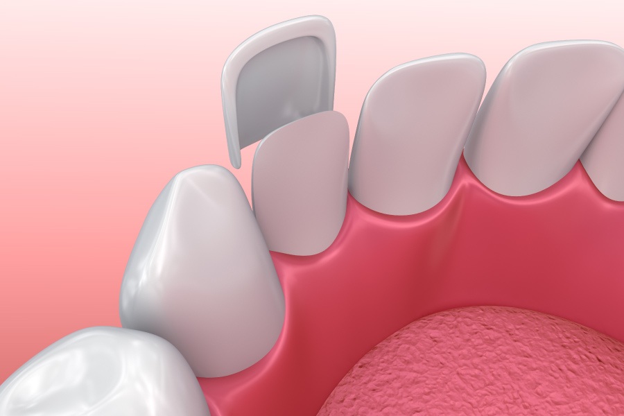 Closeup of a tooth with a dental veneer to cover discoloration and imperfections