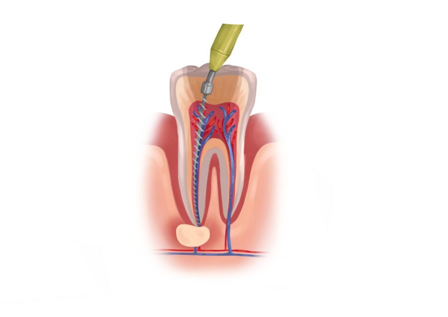root canal therapy, root canal, root canals, do root canals hurt