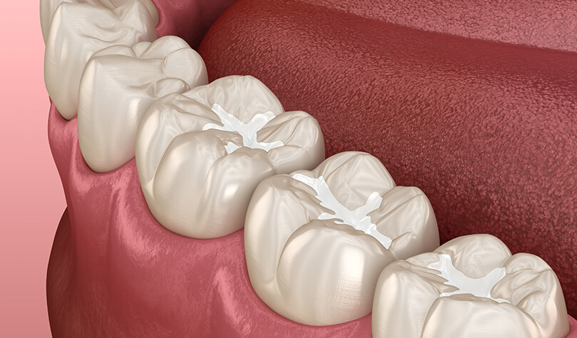 illustration of dental sealants on a row of teeth