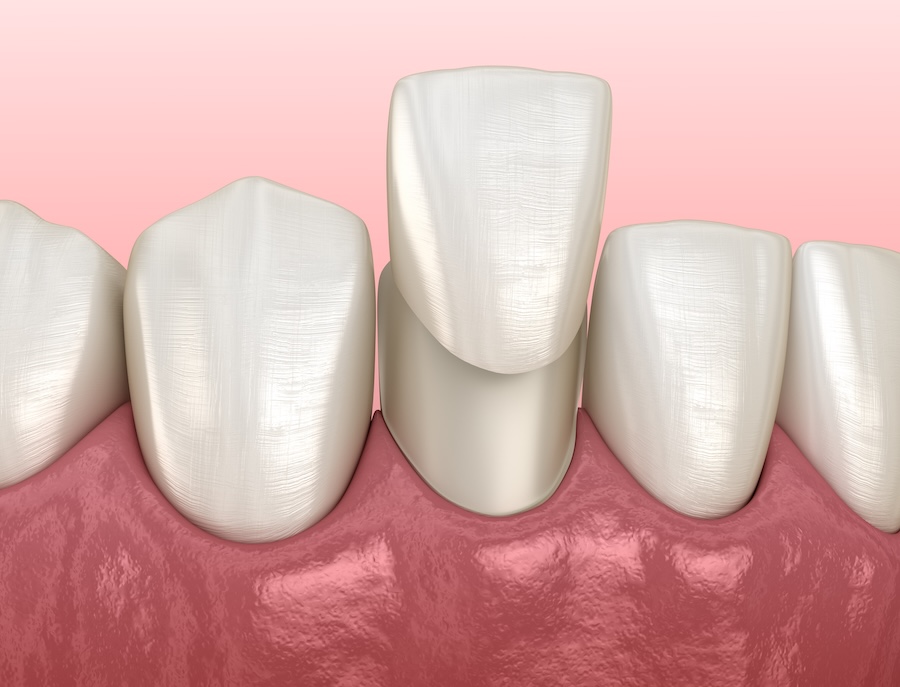 porcelain veneers, how long do veneers last and when do veneers need to be replaced