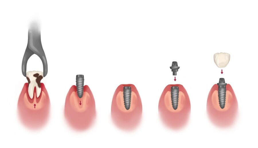 dental implant process